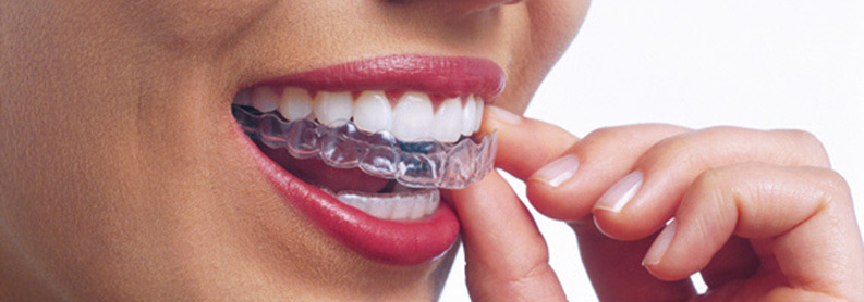 Invisalign